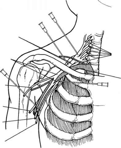 Brachial Plexus Drawing Pictures